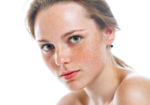 cách chăm sóc da mặt bị nám