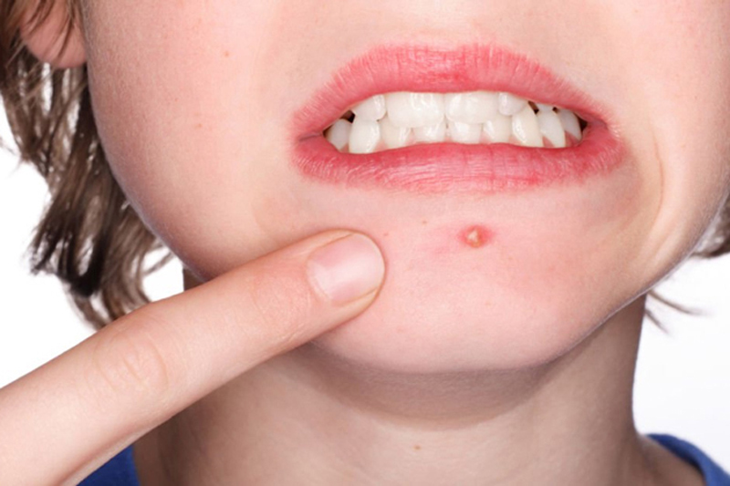 Nguyên nhân gây mụn và các phương pháp ngăn ngừa 1 Nguyên nhân gây mụn