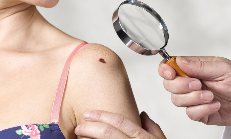 Tác hại của ánh nắng mặt trời đối với da và cách bảo vệ 5 Ánh nắng mặt trời tác nhân gây ung thư da